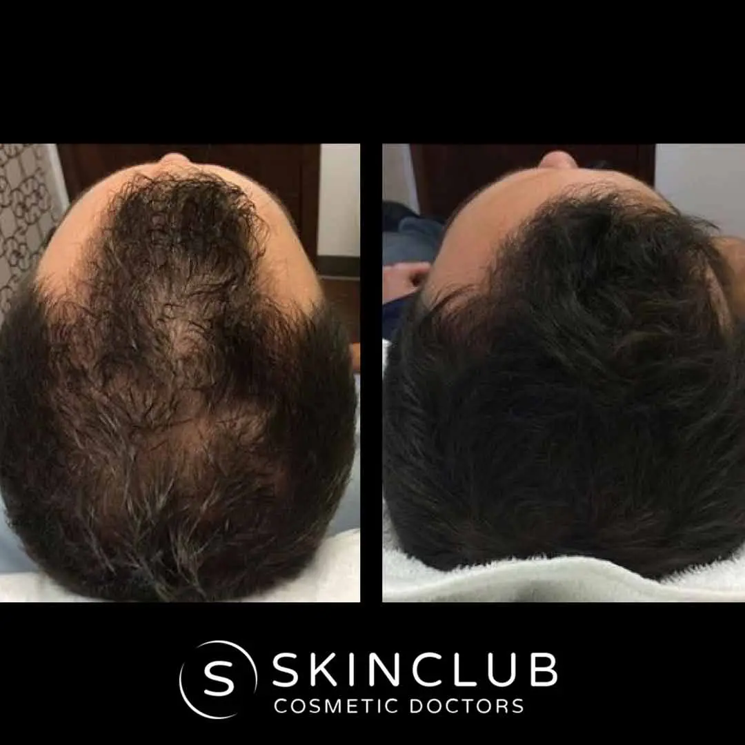PRP Hair Loss Treatment Melbourne | Skin Club Cosmetic Doctors