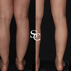 Ankle Liposuction Before and After