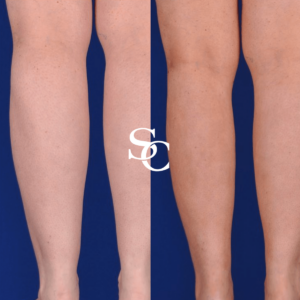 Ankle Liposuction Doctor Melbourne