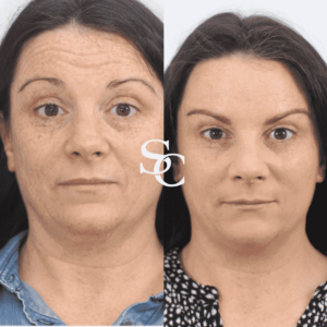 Anti Wrinkle Injections Before and after