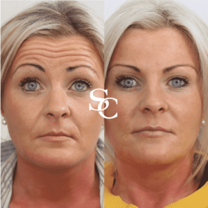 Anti Wrinkle Injections Treatment in Melbourne