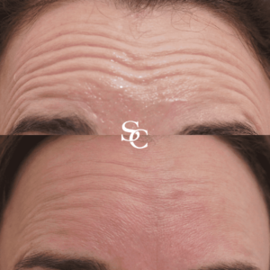 Anti Wrinkle Injections Treatment