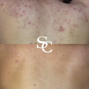 Back Acne Scars Clinic In Melbourne