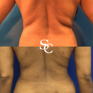 Back Liposuction Before and After
