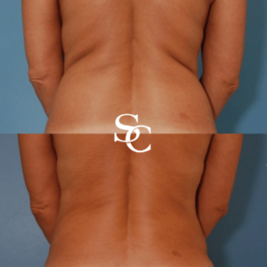 Back Liposuction Result By Skin Club