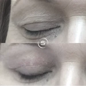 Blepharoplasty / Eyelid Surgery Before After