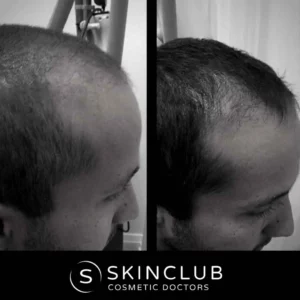 Hair loss Treatment Before-and-After