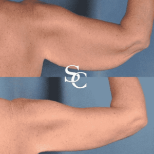 Brachioplasty Before-and-After