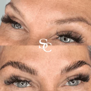 Brow Lift Treatment In Melbourne