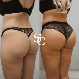 Non Surgical Butt Fillers Melbourne