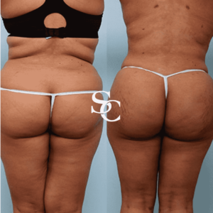 Non Surgical Butt Fillers Melbourne