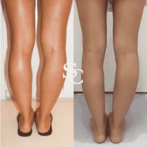 Calf Slimming Before After