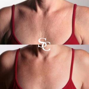 Chest Wrinkles Treatment And After