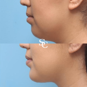 Chin Fillers Before After