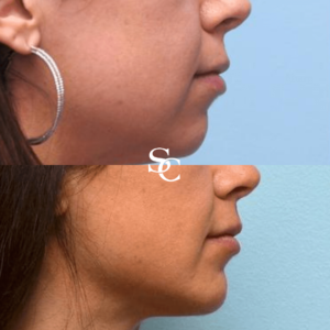 Chin Implant Melbourne