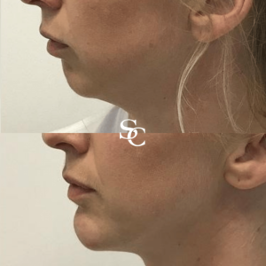 Chin-Fillers-Clinic Melbourne