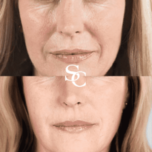 Collagen Stimulating Injections Before and After