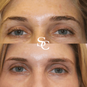 Collagen Stimulating Injections Before and Afters