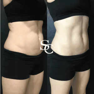 CoolSculpting Before After