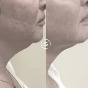 Double Chin Removal in Melbourne