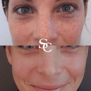 Cosmelan Peel Before-and-After