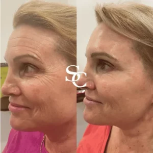 Crows feet Treatment Before After Melbourne