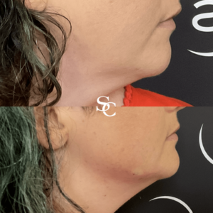 Double Chin Removal Before After
