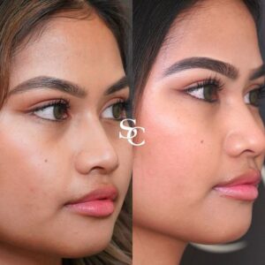 Dull Skin Before And After