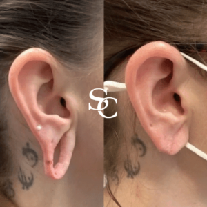 Earlobe Repair Before and Afters