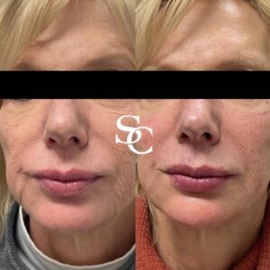 Face Liposuction Treatment