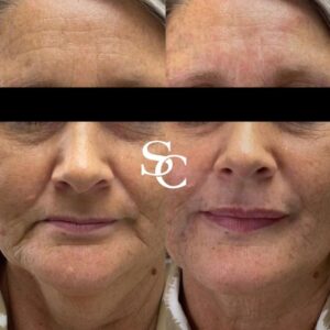 Face Liposuction Before and After