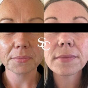 Face Liposuction Clinic Melbourne