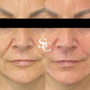 Face Liposuction Melbourne