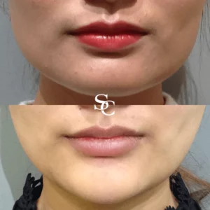 Face Slimming Before and Melbourne