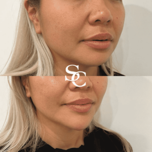 Face Slimming Before and after