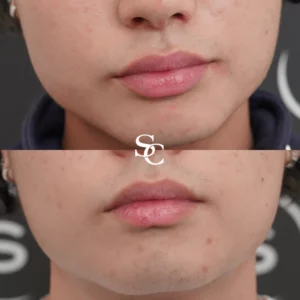 Face Slimming result by Skin Club