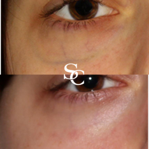Facial Vein Removal Before and after Melbouorne