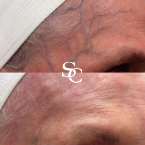Facial Vein Removal Treatment Before and After
