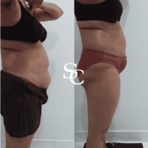 Fat Freezing Before and After