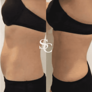Fat Freezing Treatment Before and After