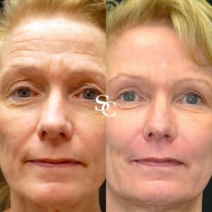 Forehead Fillers Before and After By Skin Club
