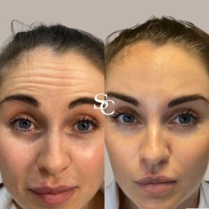Forehead Fillers Treatment