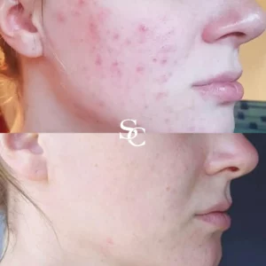 Fraxel Laser before and-after