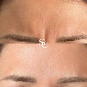 Frown Line Filler Before And After