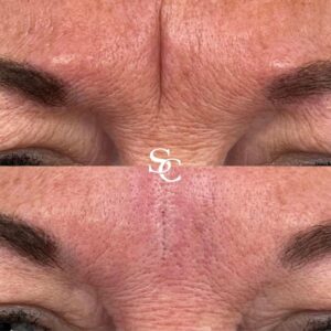 Frown Line Filler Treatment