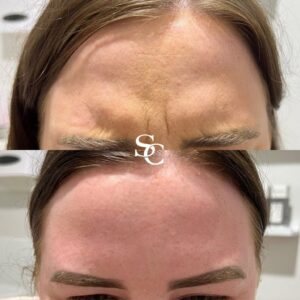 Frown Line Filler Before And After