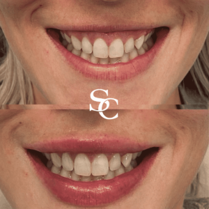 Gummy Smile Treatment Before and After