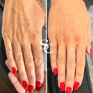 Hand Rejuvenation Before And After