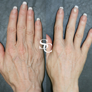 Hand Veins Before After