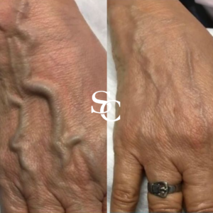 Hand Veins Before After Result